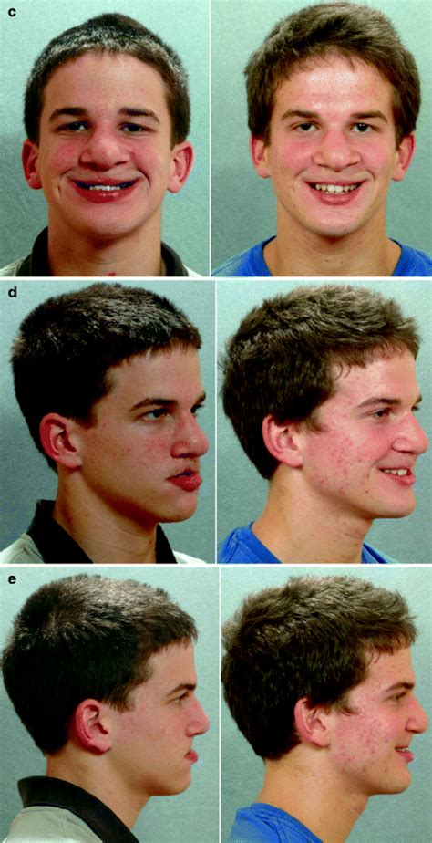 Cleft Jaw Deformities And Their Management Pocket Dentistry