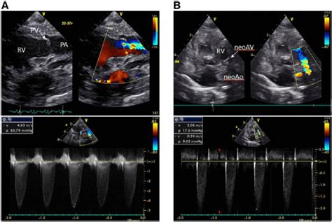 A A Transthoracic Echocardiogram After Birth Reveals A Severely