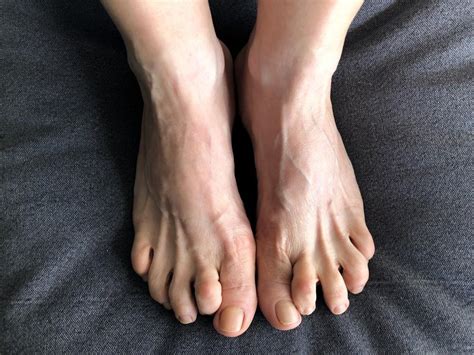 When To See A Specialist About Your Hammertoes Phoenix Foot And Ankle