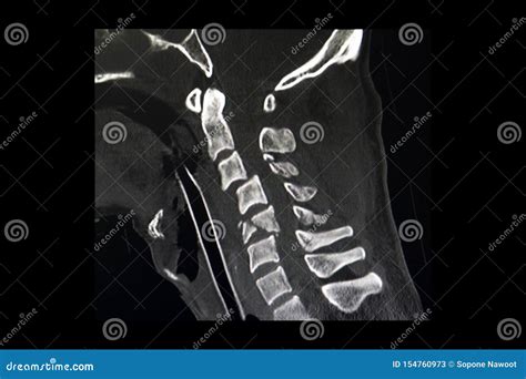 Ct Scan Of Fractures Cervical Spines Stock Image Image Of Bursted