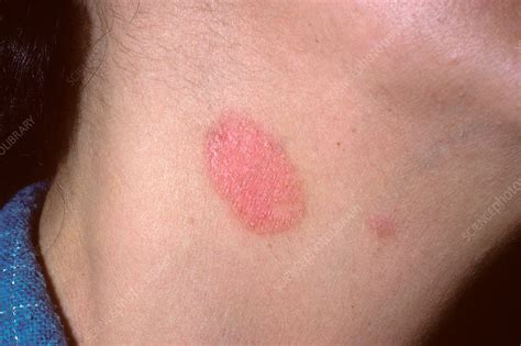 Ringworm Fungal Infection Stock Image C034 8796 Science Photo Library