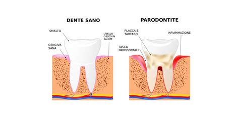 Parodontologia Dentista San Severo Dottssa Alessandra Nardella