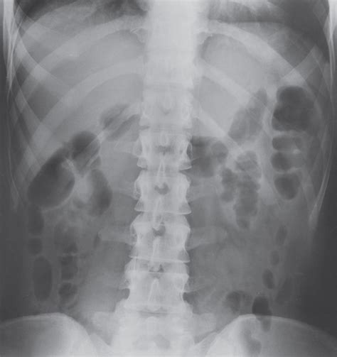 Flat Plate Of The Abdomenabdominal X Ray Diagram Quizlet