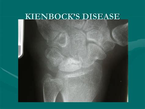 Ppt Kienbocks Disease Powerpoint Presentation Free Download Id