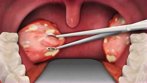 How To Remove Tonsil Stones By Dentists Bad Breath Causes And Remedy