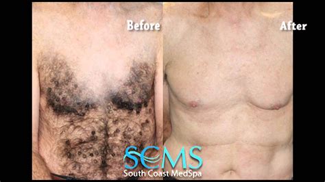 Newport Beach Laser Hair Removal Chest And Abs Beforeafter Youtube