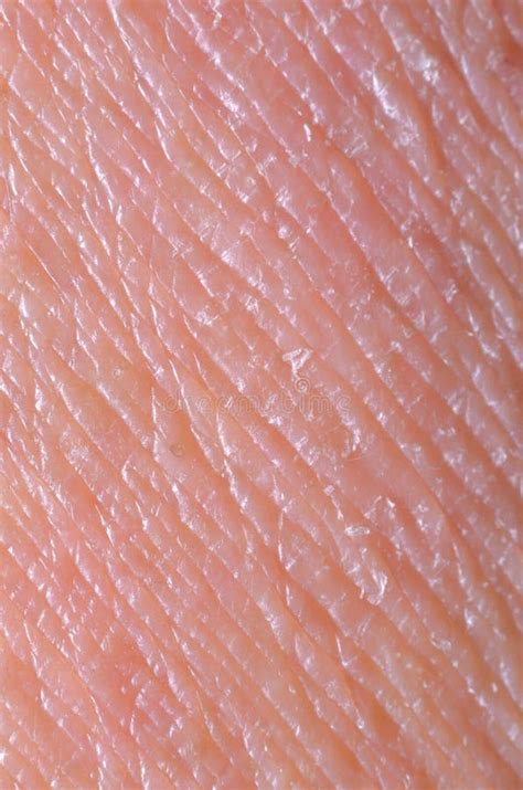 Dry Skin Stock Image Image Of Hospital Lesion Eczema 34808355