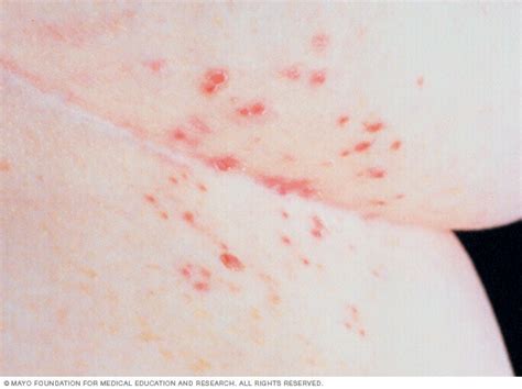 scabies mayo clinic