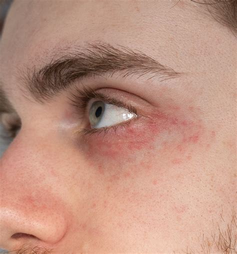 Skin Concern At A Loss Trying To Deal With This Rash Around My Eyes