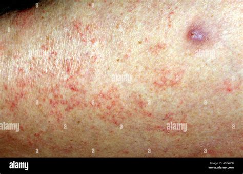 Scabies Lesions Stock Photo 4055498 Alamy