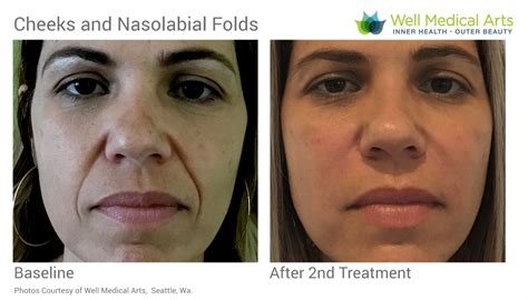 Cheeks And Nasolabial Folds Well Medical Arts Seattles Anti Aging