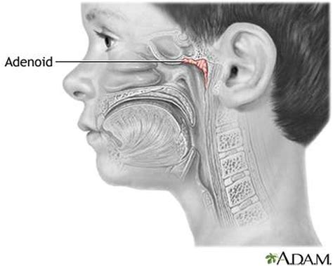 Pictures Of Adenoids