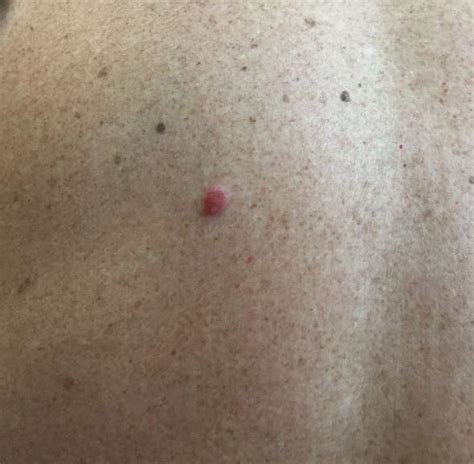 Asymptomatic Nodule On The Back Mdedge Dermatology