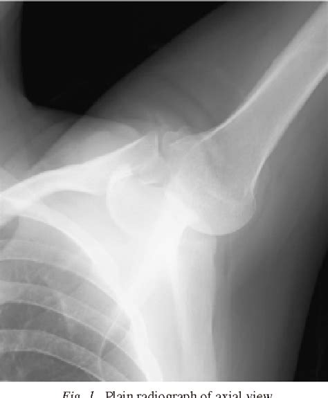 Figure 1 From Isolated Fracture Of The Lesser Tuberosity Of The Humerus