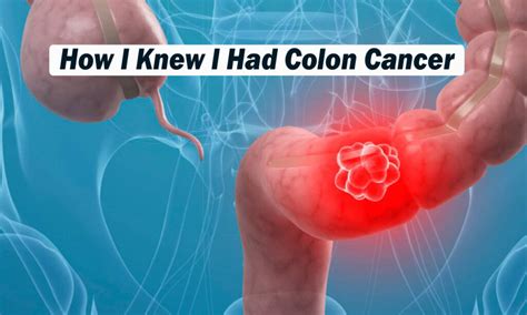 How I Knew I Had Colon Cancer Healthteps