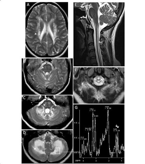 Brain And Spinal Cord T2 Weighted Mri Representative Of Lbsl A D F