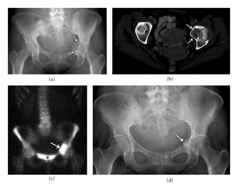 Figure 7 Imaging Review Of Skeletal Tumors Of The Pelvis—part I