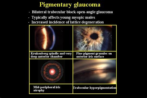 Secondary Glaucomas 1 Pseudoexfoliation Glaucoma 2 Pigmentary Glaucoma