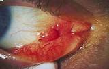 Pictures of Conjunctival Pyogenic Granuloma Treatment
