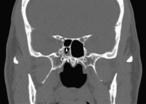 Ct Scan Of The Sinuses Coronal View At The Level Of The Sphenoid