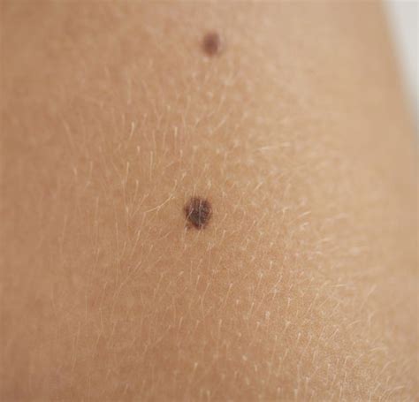 Comment vérifier qu'ils ne sont pas cancéreux ? Grains de beauté : comment les surveiller ? - Puretrend