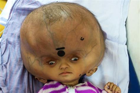 Baby With Worlds Biggest Head Stuns Medics In India As