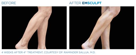 The Game Changer For Body Contouring Emsculpt Fort Worth Tx — The