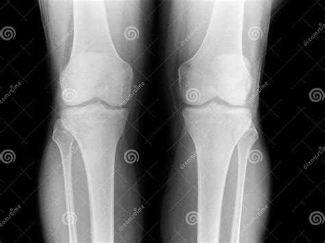 X Ray Of The Knee Stock Image Image Of Clinical Examination 24596497