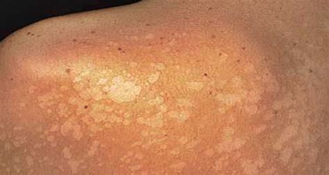 Pityriasis Alba Causes And Symptoms Of This Skin Disorder