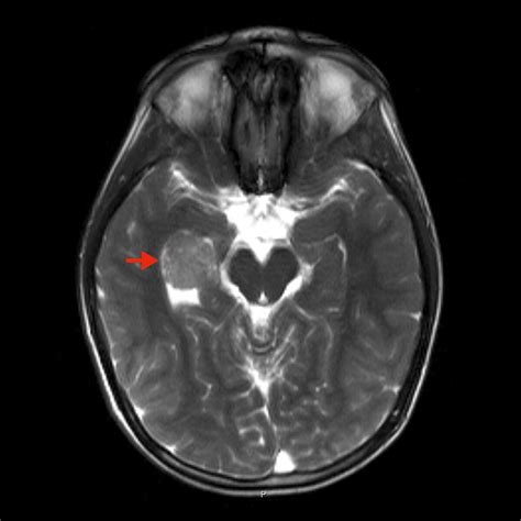 Plexustumor Diagnose Und Therapie Neurochirurgie Inselspital Bern