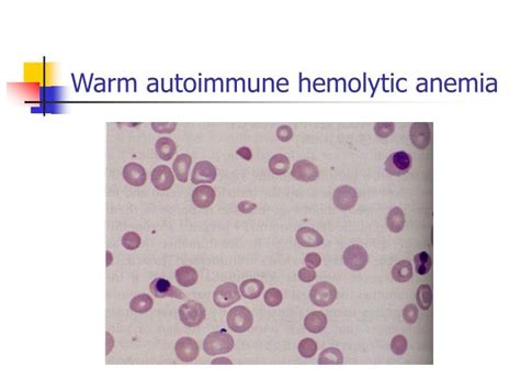 Ppt Hemolytic Anemias Extracorpuscular Defects