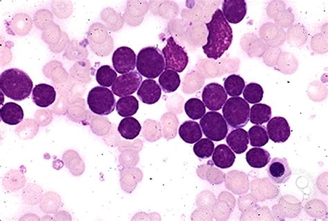 Precusor B Cell Acute Lymphoblastic Leukemia 2