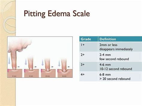 Pitting Edema Timing Scale