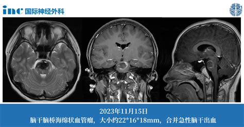 脑干海绵状血管瘤2次出血手术的时机何时？ Inc国际神经外科医生集团