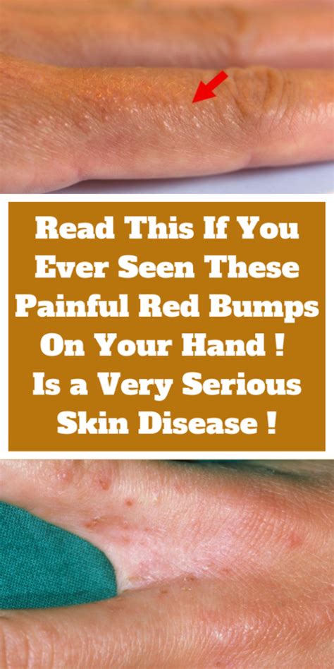 These Itchy Red Bumps Are Actually A Very Serious Skin Disease