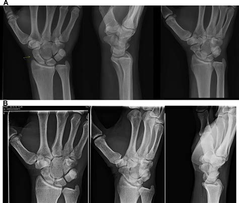 Fractures Of The Carpal Bones Clinics In Plastic Surgery