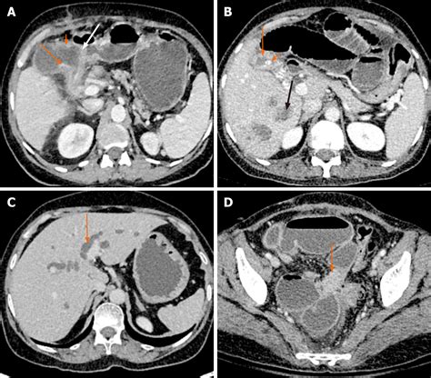 Imaging Based Algorithmic Approach To Gallbladder Wall Thickening