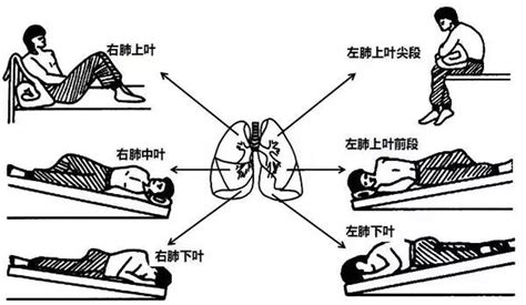 6种“体位排痰法”简单易学，排痰时如何咳嗽也有具体方法 科普头条 看呼吸