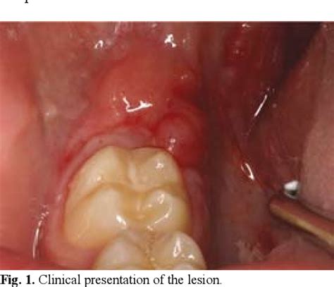 Figure 1 From Unifocal Orofacial Granulomatosis In Retromolar Mucosa