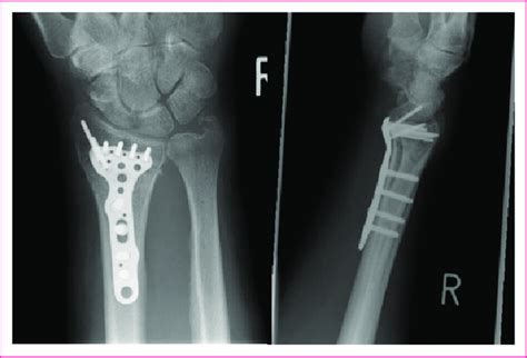 A Distal Radius Fracture Stabilised With A Locking Plate Download