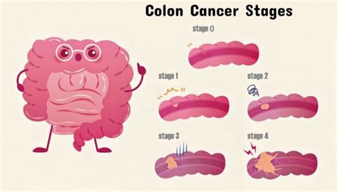 Colon Cancer Early Warning Signs And Stages Of Colon Cancer Page 11