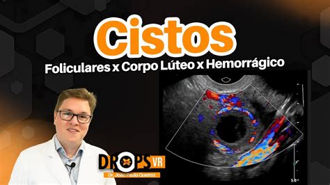 CISTOS OVARIANOS FUNCIONAIS FOLICULARES DE CORPO LÚTEO E