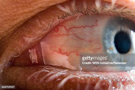 Blood Vessels In The Eye Photos And Premium High Res Pictures Getty