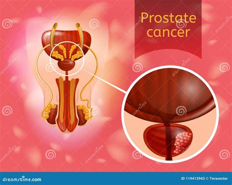 Prostate Cancer Realistic Vector Anatomical Scheme Stock Vector Illustration Of Diagram