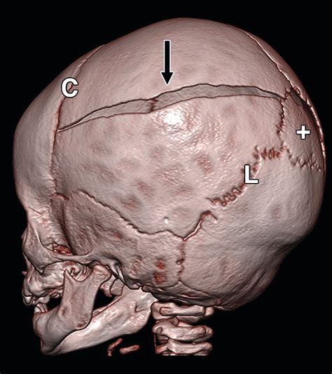 Pediatric Skull Fractures Contacting Sutures Relevance In Abusive Head