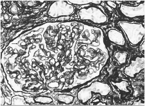We did not find results for: Focal reduplication of the glomerular capillary basement ...