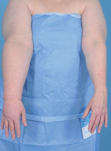Lymphedema Diagnosis And Treatment Plastic Surgery