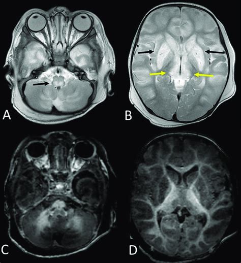 Axial T2 Weighted A And B And T1 Weighted C And D Mr Images Show