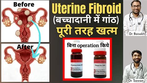 Homeopathic Medicine For Uterine Fibroids Uterine Fibroid Treatment