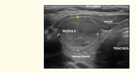 Figure 1 From The Thyroid Nodule New Diagnostic Andtherapeutic